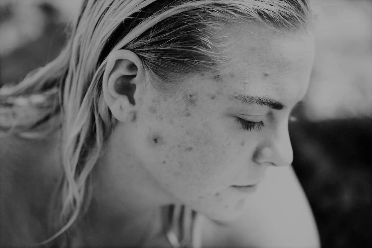 Acne combattere